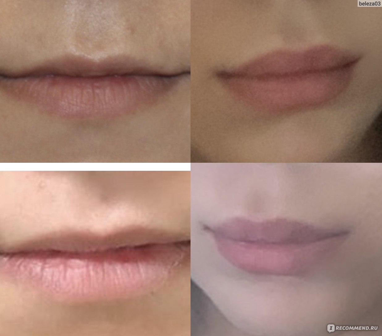 Увеличение губ хирургическим путем фото до и после