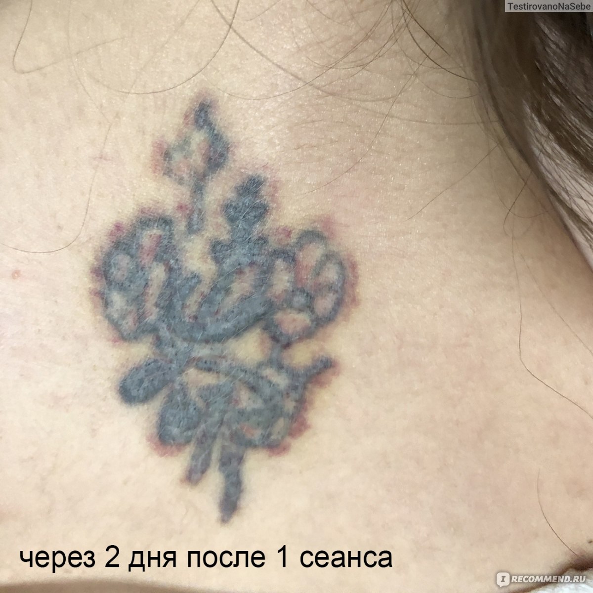 Лазерное удаление татуировок и перманентного макияжа в Минске