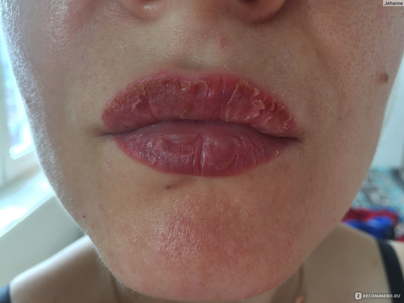 Вирус герпеса после перманентного макияжа губ. Профилактика и причины появления