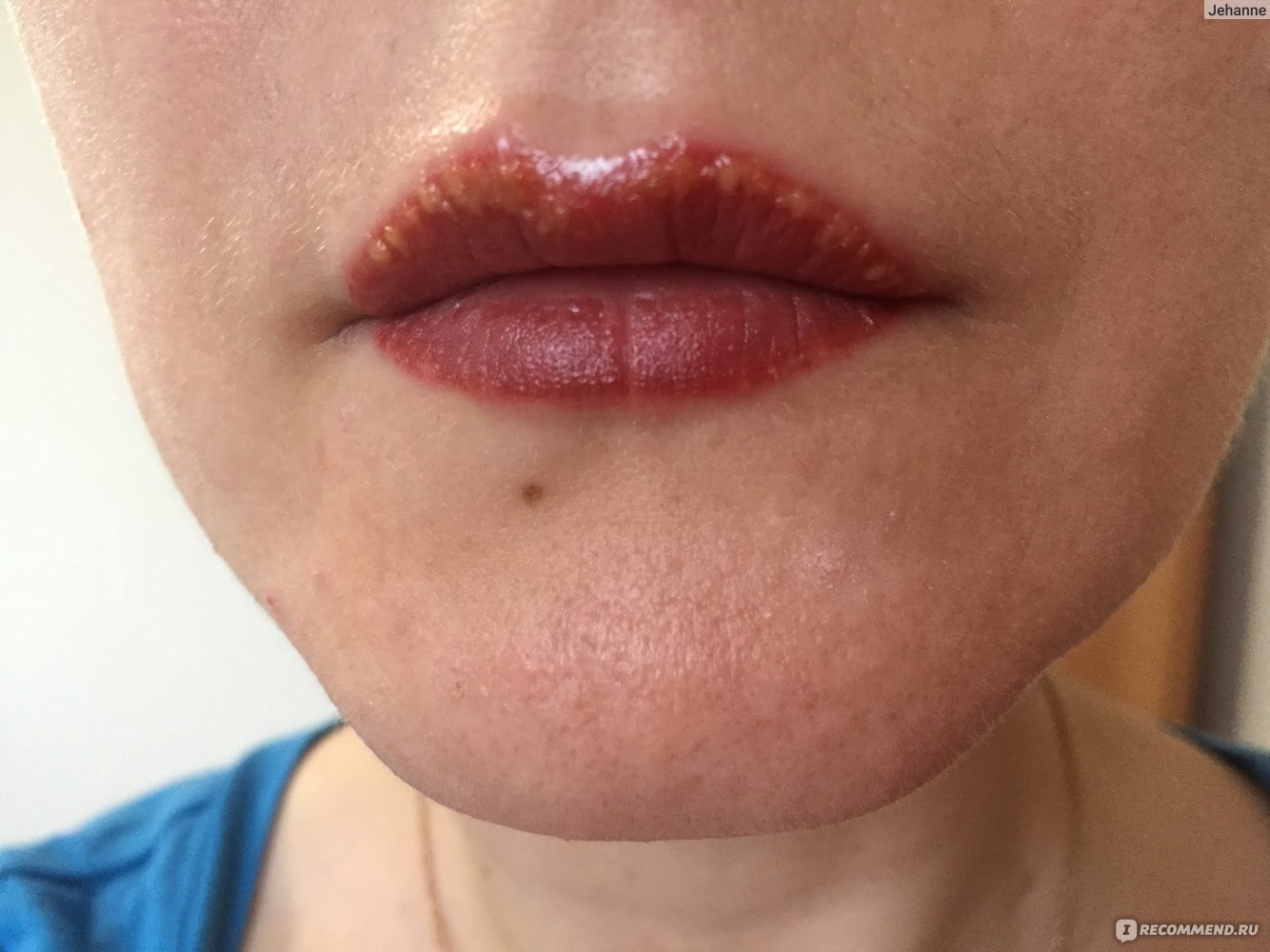 Herpes after lip augmentation: how to treat and who is to blame