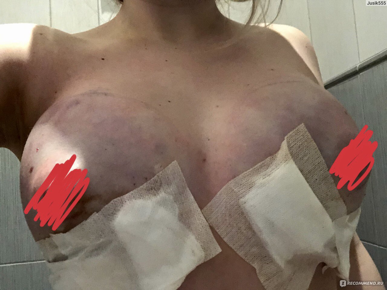 гнойные раны на груди у женщин фото 70