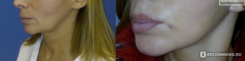 Хейлопластика - увеличение губ хирургическим путем фото