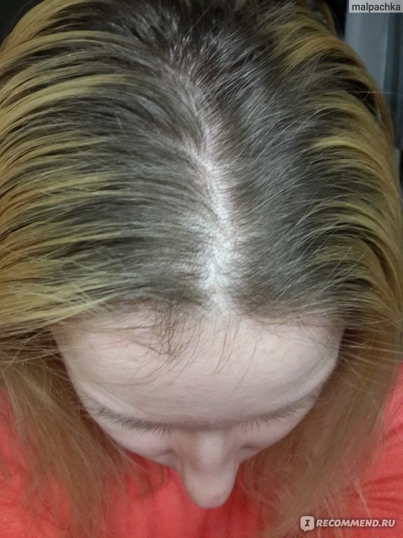 Жирные белые волосы у корней