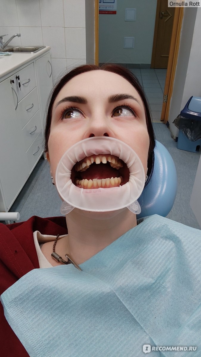 Протезирование зубов. Безметалловые керамические коронки фото