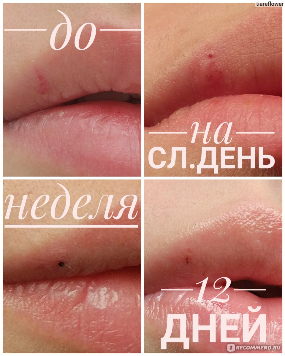 Лечение гемангиомы на губе - клиника лазерной косметологии в Москве