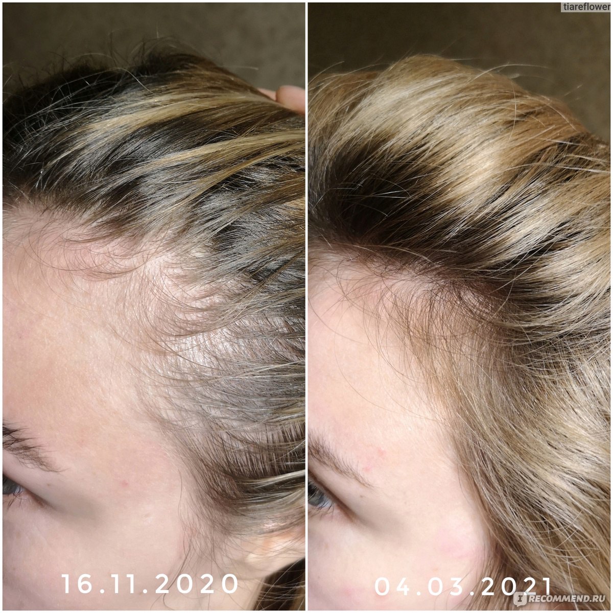 Пантовигар витамины для волос до и после