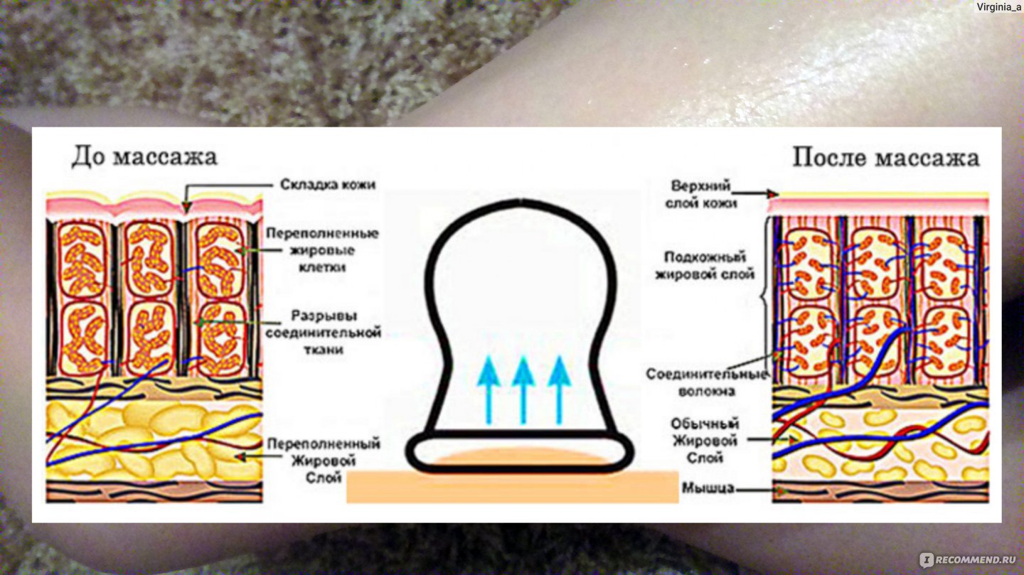 Антицеллюлитный массаж банками вакуумными схема