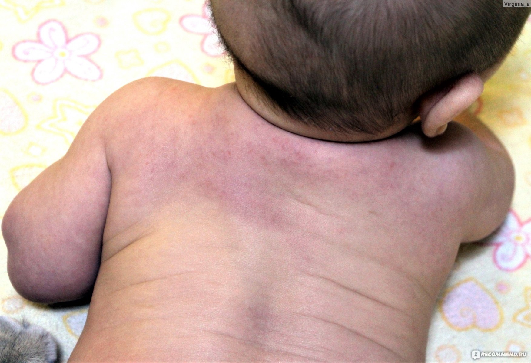 Причины сухой кожи у новорожденного