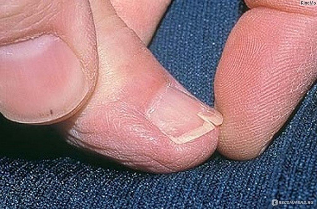 Заболевания ногтей: причины, симптомы и методы лечения