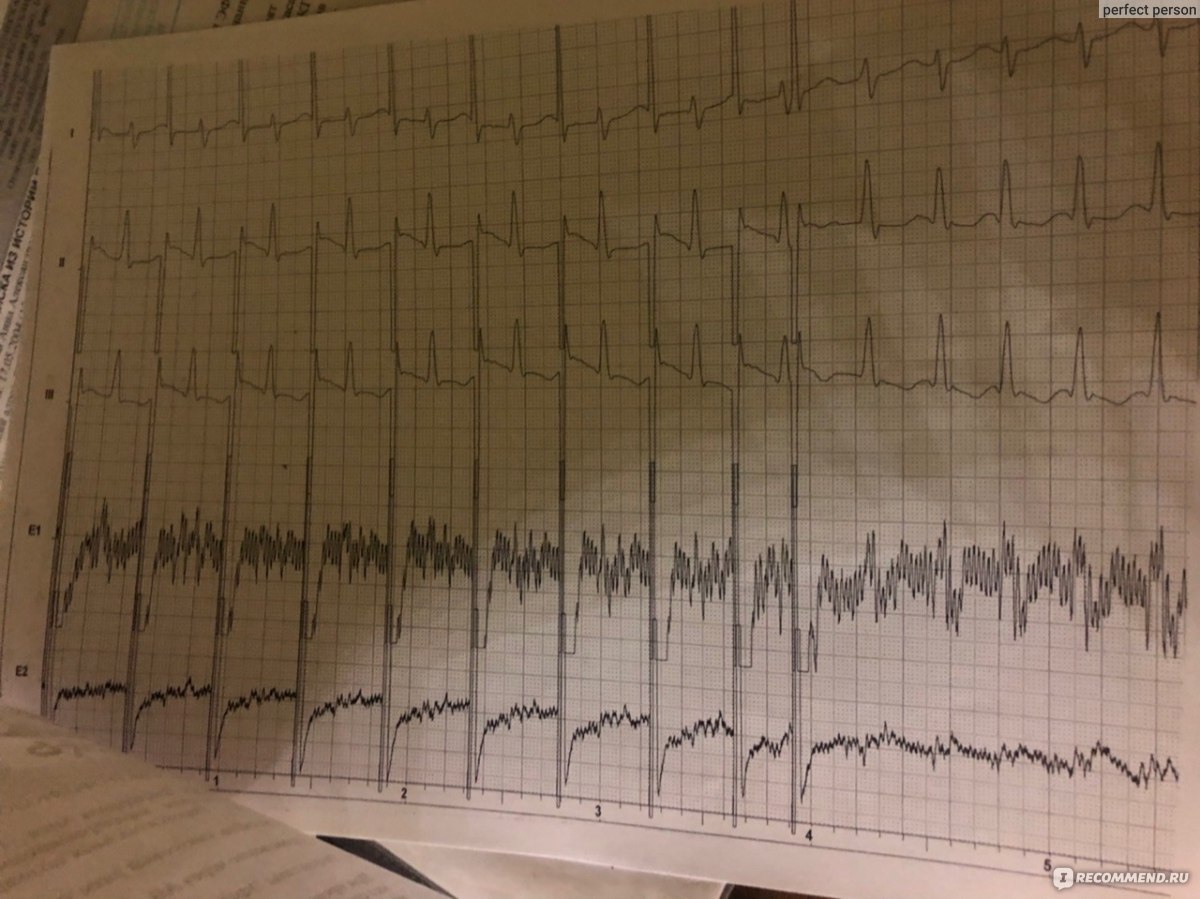Чреспищеводное электрофизиологическое исследованиие - «единственное, что  помогло определить заболевание» | отзывы