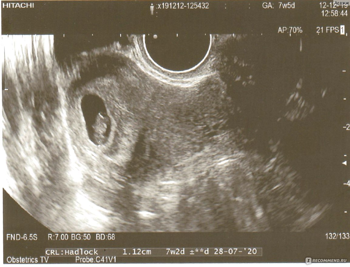 Пять недель 4 дня. УЗИ на 7,4 недели беременности. УЗИ на 7 акушерской неделе беременности. Как выглядит УЗИ на 7 неделе беременности. УЗИ матки на 7 неделе беременности.