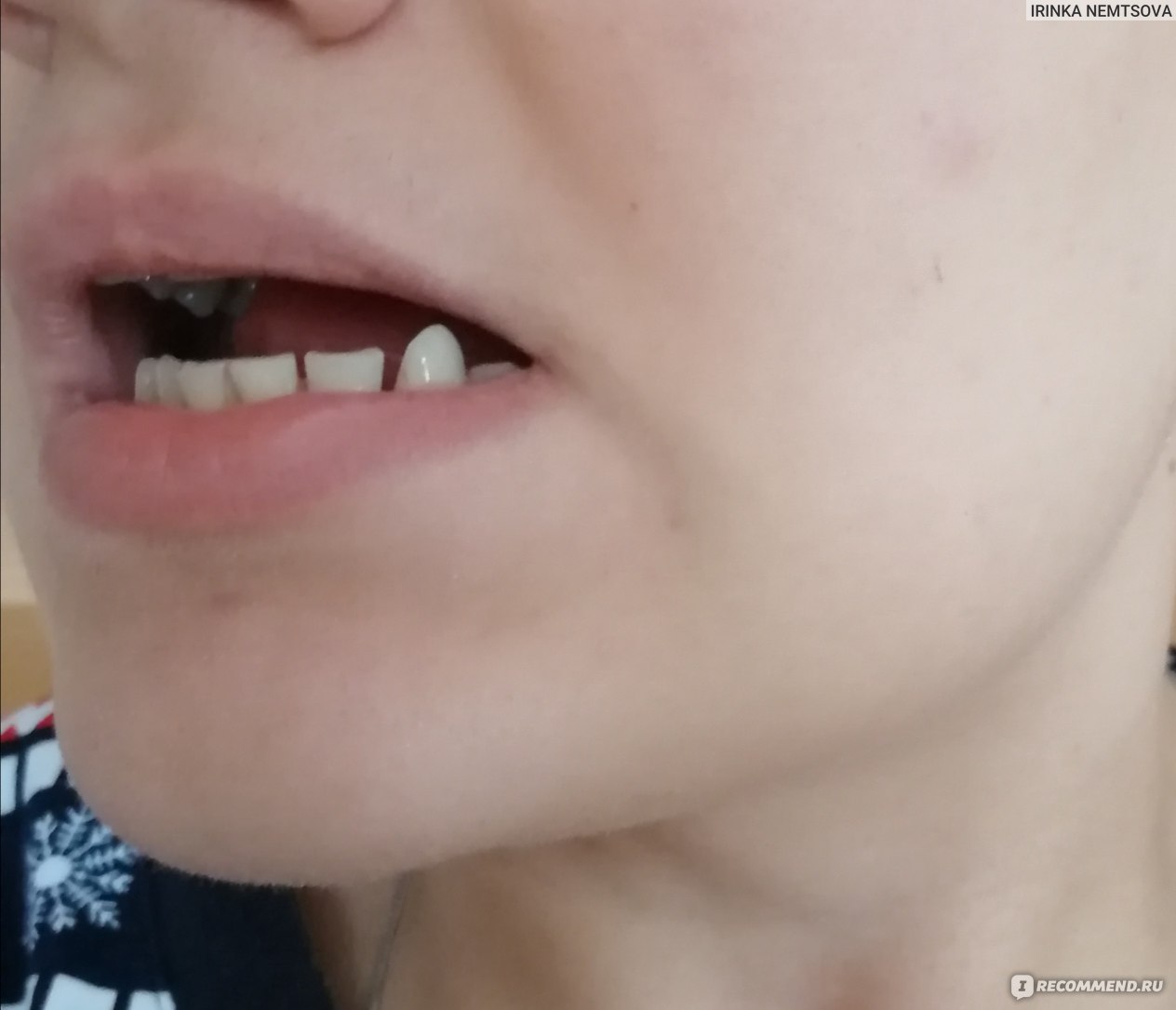 подпилить клыки. не ртвные передние зубы. подпиливание передних зубов до и после. подпилить клыки. подпилить клыки.