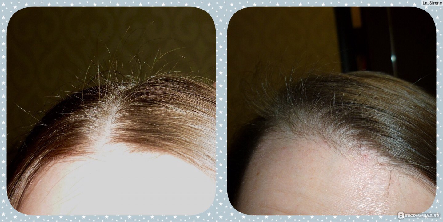 Как правильно выбрать и использовать Дарсонваль для волос?