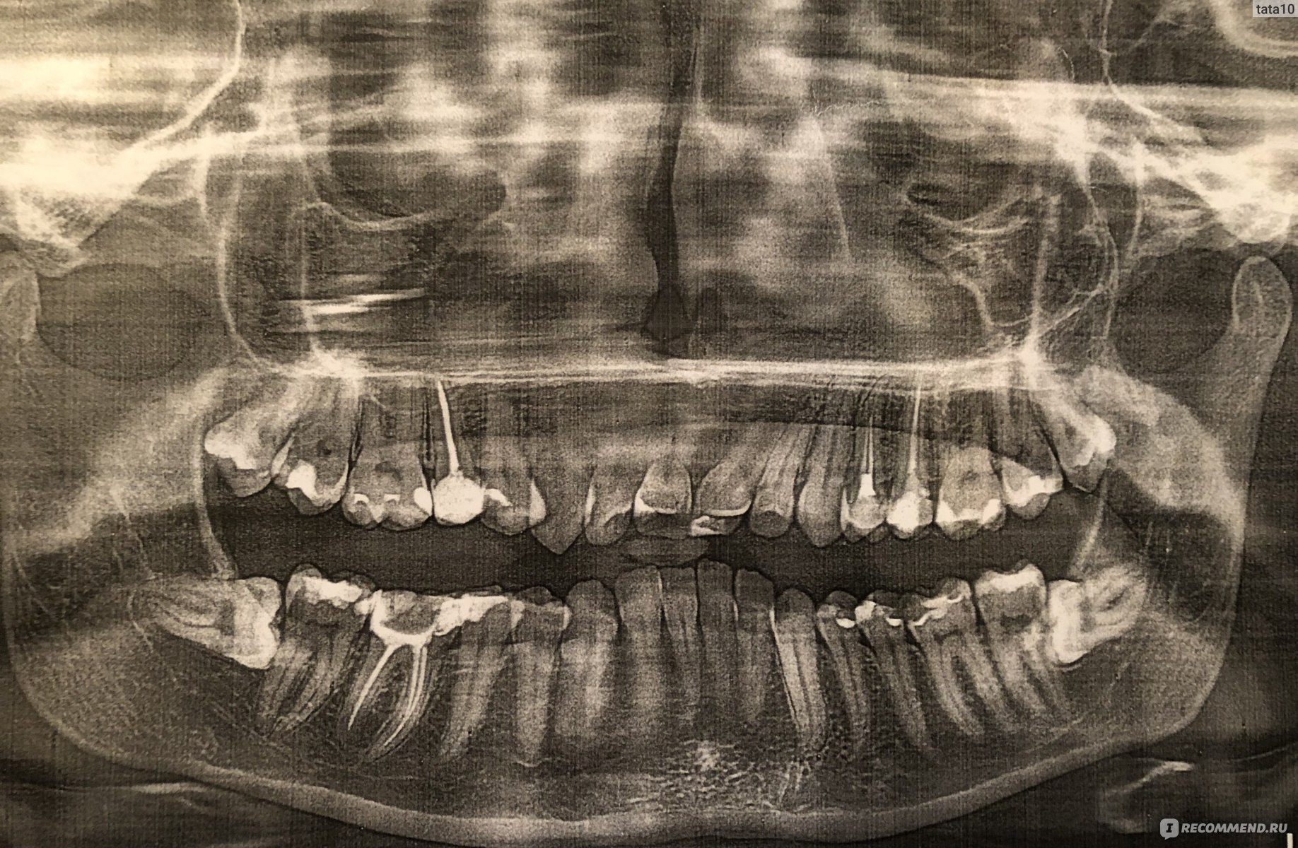 осколки после удаления зуба фото
