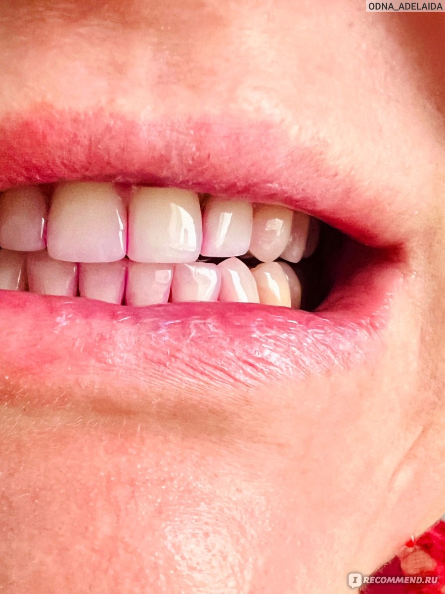 Внутрикостные дентальные имплантаты. Импланты дентиум 3412. Виниры комплект snap-on smile. Имплантаты в стоматологии. Аппарат для выправления челюсти.