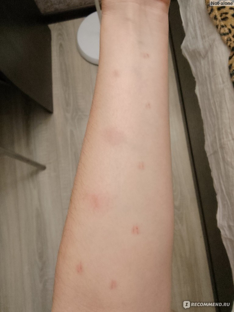 Аллергия на шерсть животных, домашнюю пыль