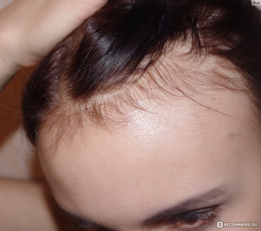 Симптомы и причины поредения волос