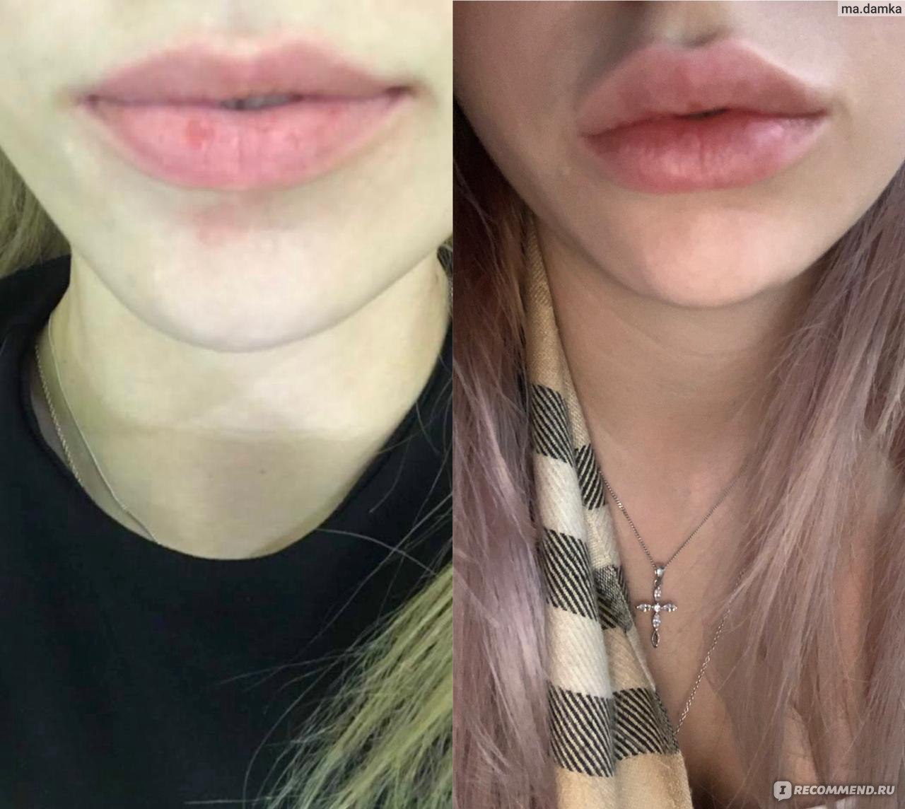 Зажившие губы после увеличения