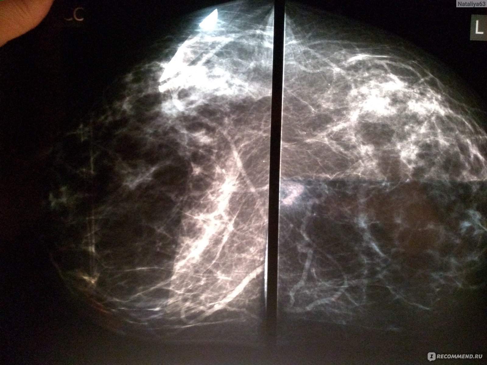 Что такое маммография молочных желез фото