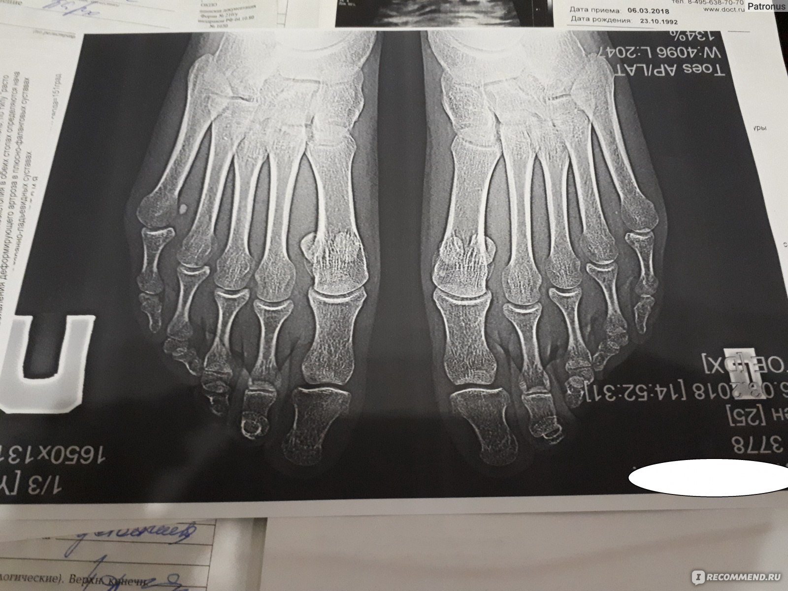Рентген стопы норма фото в двух проекциях
