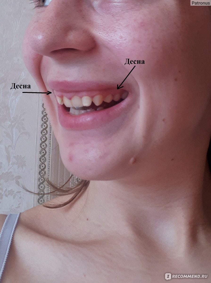 Десневая улыбка. Методы коррекции. Пример коррекции десневой улыбки Ботоксом (Botox).