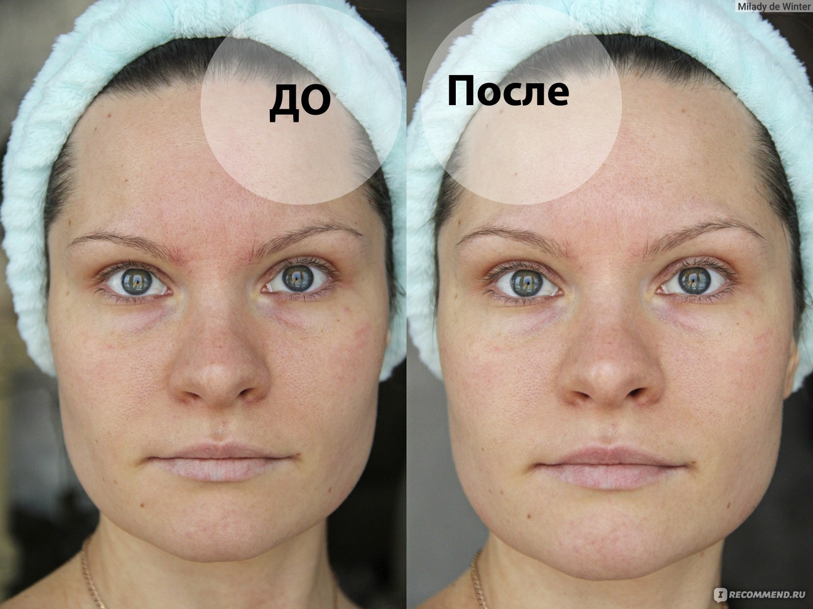 Лифтинг косметика для лица фото до и после