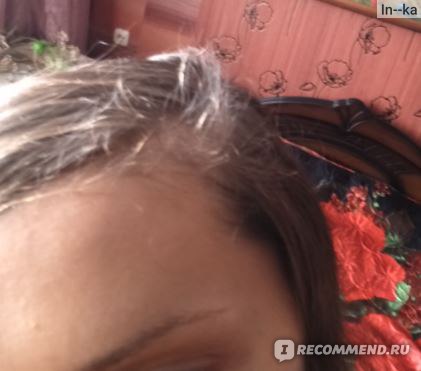 Мезотерапия волос кожи головы в Москве