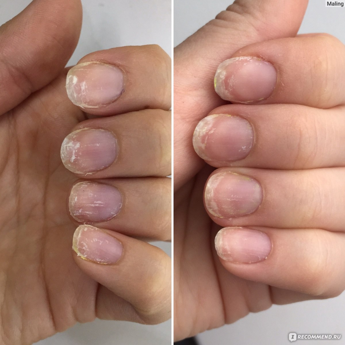 Восстановление ногтей после гель лака средства. Ногти после снятия гель лака.