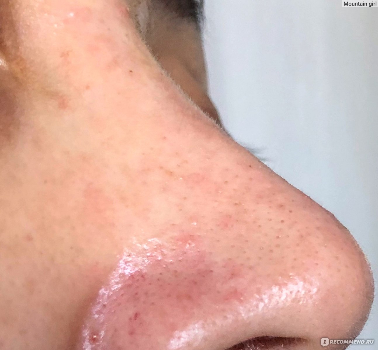 Салфетки для удаления черных точек Ciracle Pore Control Blackhead Off Sheet  - «Очистил поры, но больше не куплю! Фото не для брезгливых » | отзывы