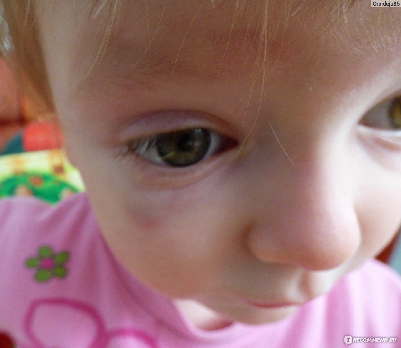 У ребенка темные круги под глазами почему. Синева под глазами у ребенка. Синячки под глазами у ребенка. Круги под глазами у ребенка.