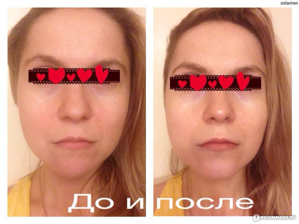 фотографии до и после применения тканевой маски otome в домашних условиях