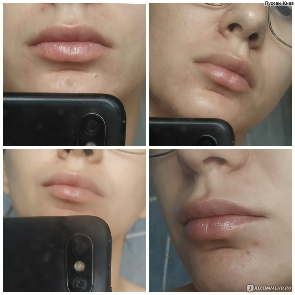 уменьшение малых губ фото до и после