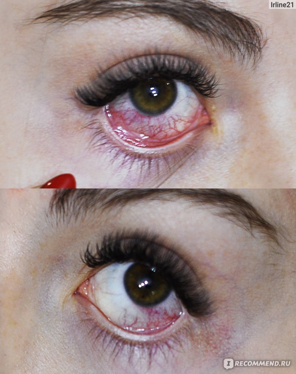 Красные глаза после наращивания – почему это происходит