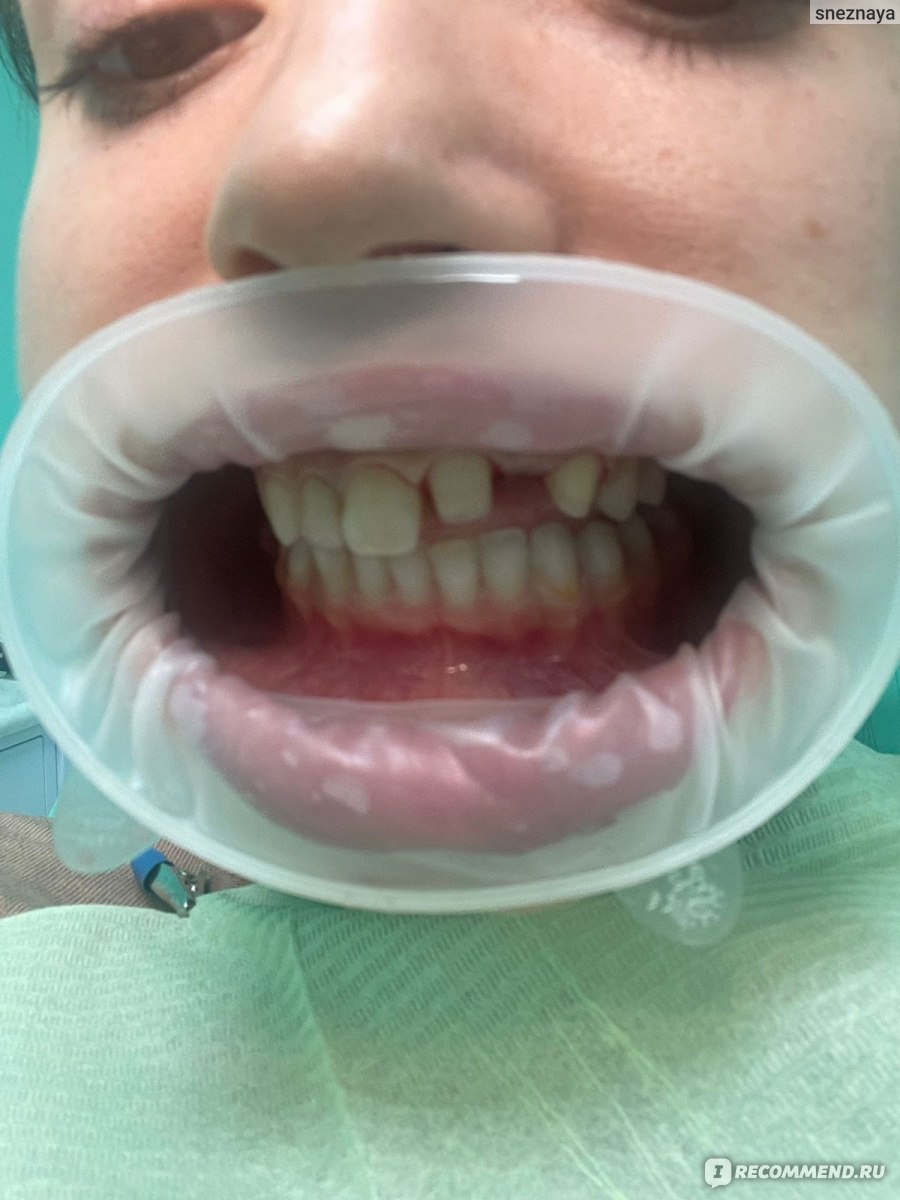 Протезирование зубов. Безметалловые керамические коронки фото