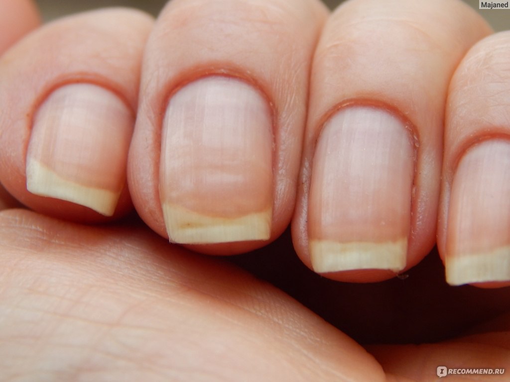 Ребристые полосы на ногтях. Ониходистрофия - онихолизис.. Поперечные борозды бо-Рейли. Борозды бо-Рейля на ногтях. Лейконихия продольная.