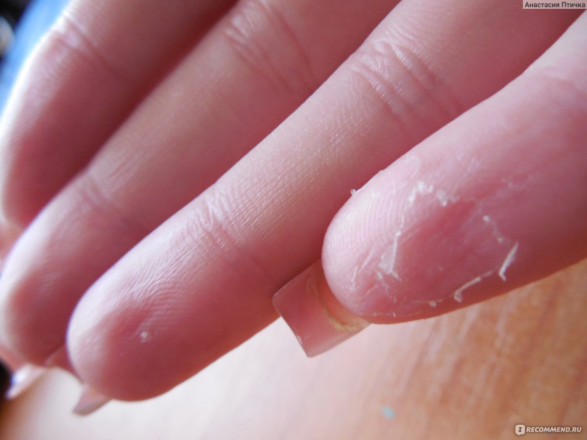 Ломкие ногти шелушение кожи
