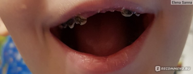 Почему чернеют зубы у детей и взрослых и что с этим делать