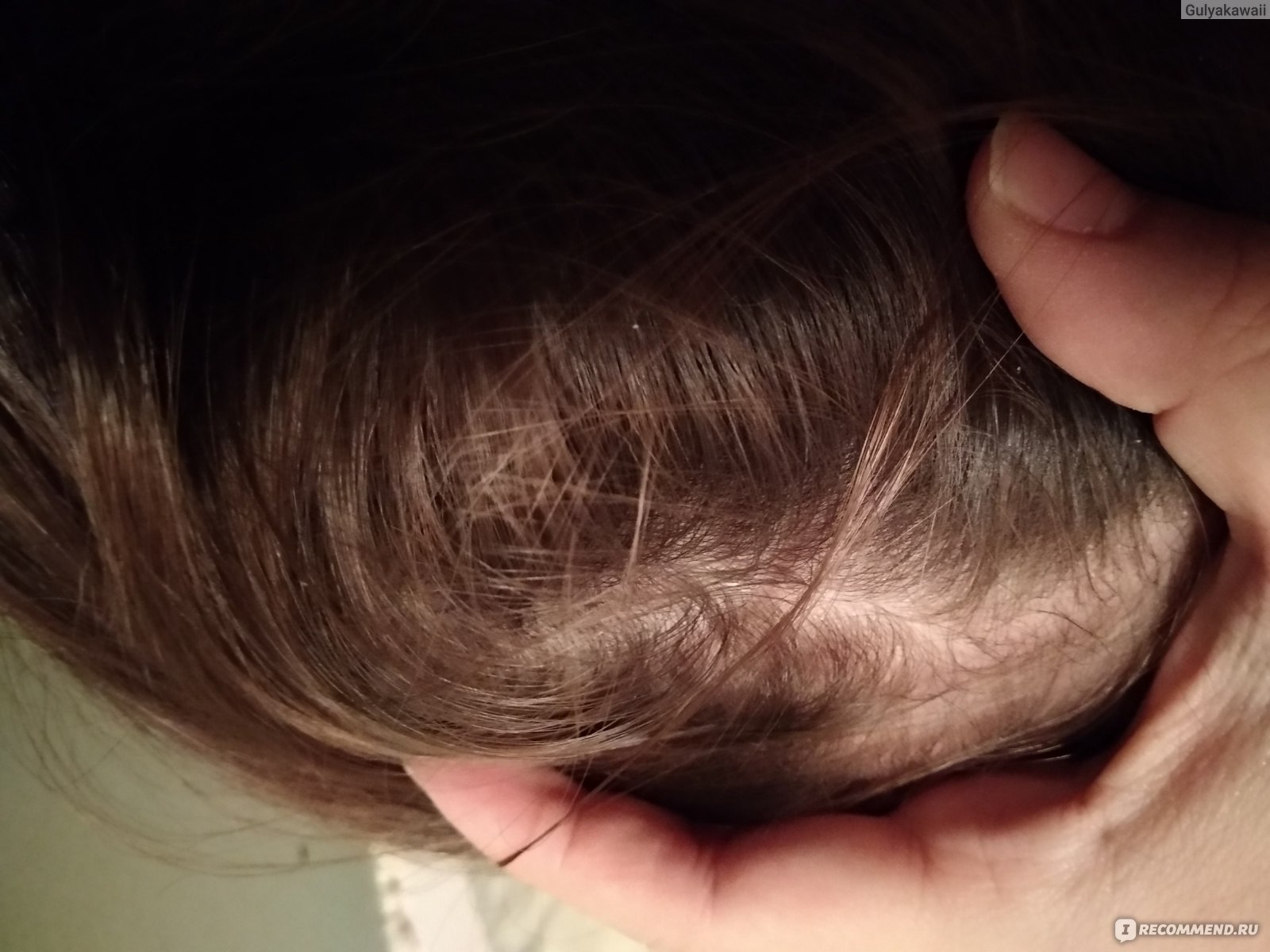 Маски в домашних условиях для волос против перхоти. Домашние средства от сухой перхоти