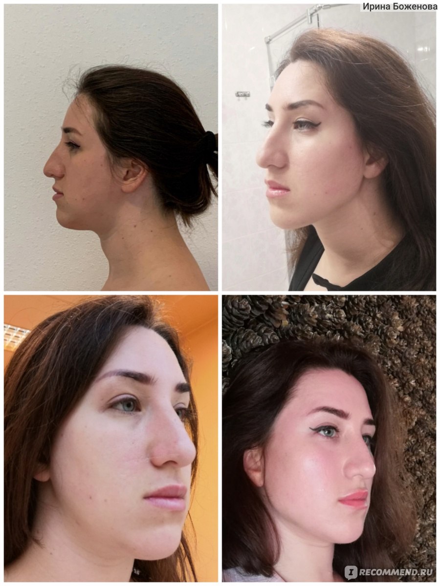Углы джоли на круглое лицо фото до и после