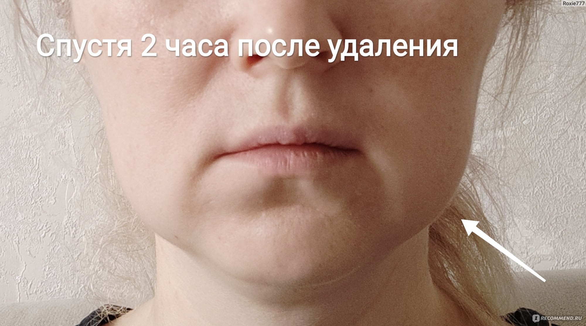 Отек после удаления мудрости. Отек после ретинированной восьмерки. Отек после удаления ретинированного зуба. Опухоль после удаления верхней восьмерки. Отек после удаления ретинированного зуба мудрости.