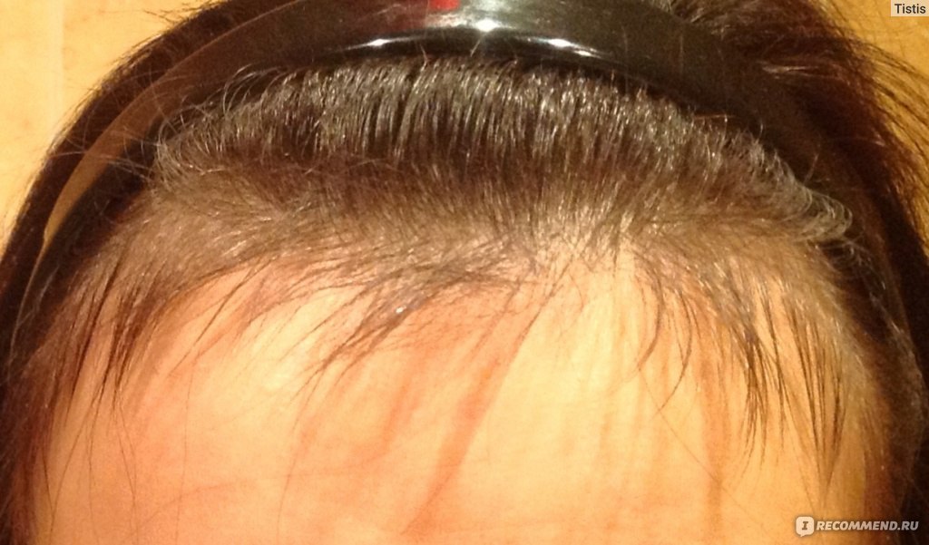 Кормящих выпадают волосы. Послеродовое выпадение волос. Подшерсток на голове у женщин. Подшерсток новых волос на голове.