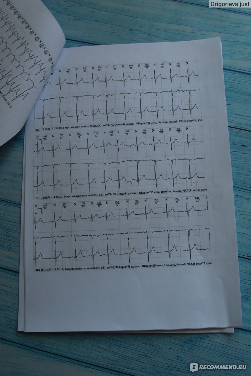 Холтеровское мониторирование ЭКГ - «Холтер для подростка | Суточный  мониторинг работы сердца» | отзывы
