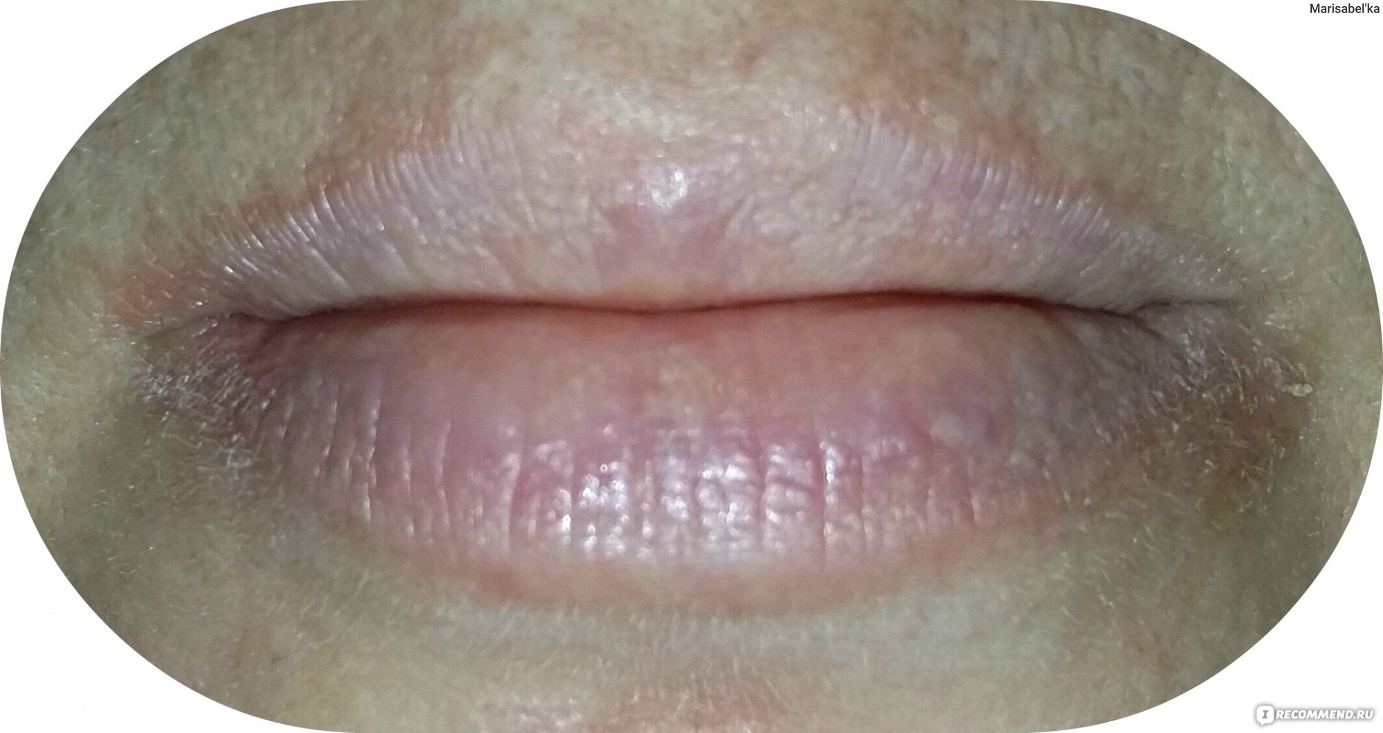 Шелушение кожи в уголках губ