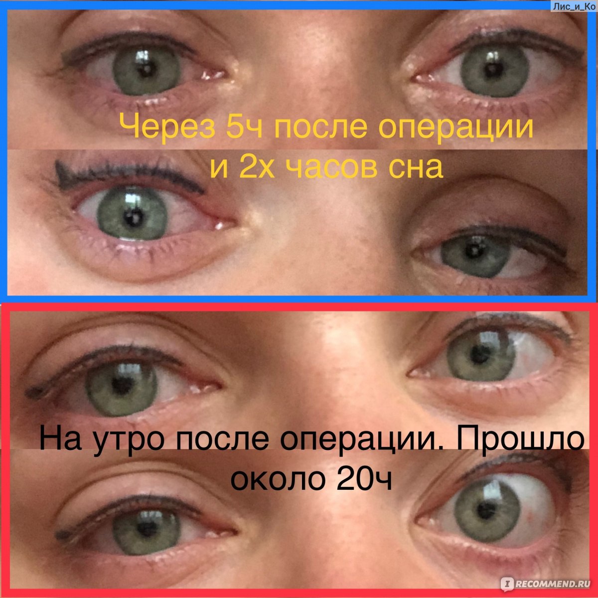 После лазерной коррекции зрения что нельзя делать. Глаза после лазерной коррекции. Глаза после лазерной коррекции зрения. До и после коррекции зрения.