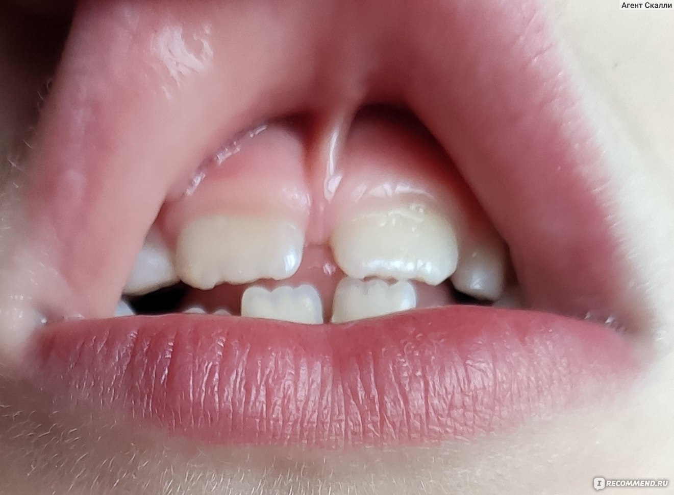 Коррекция уздечки губы