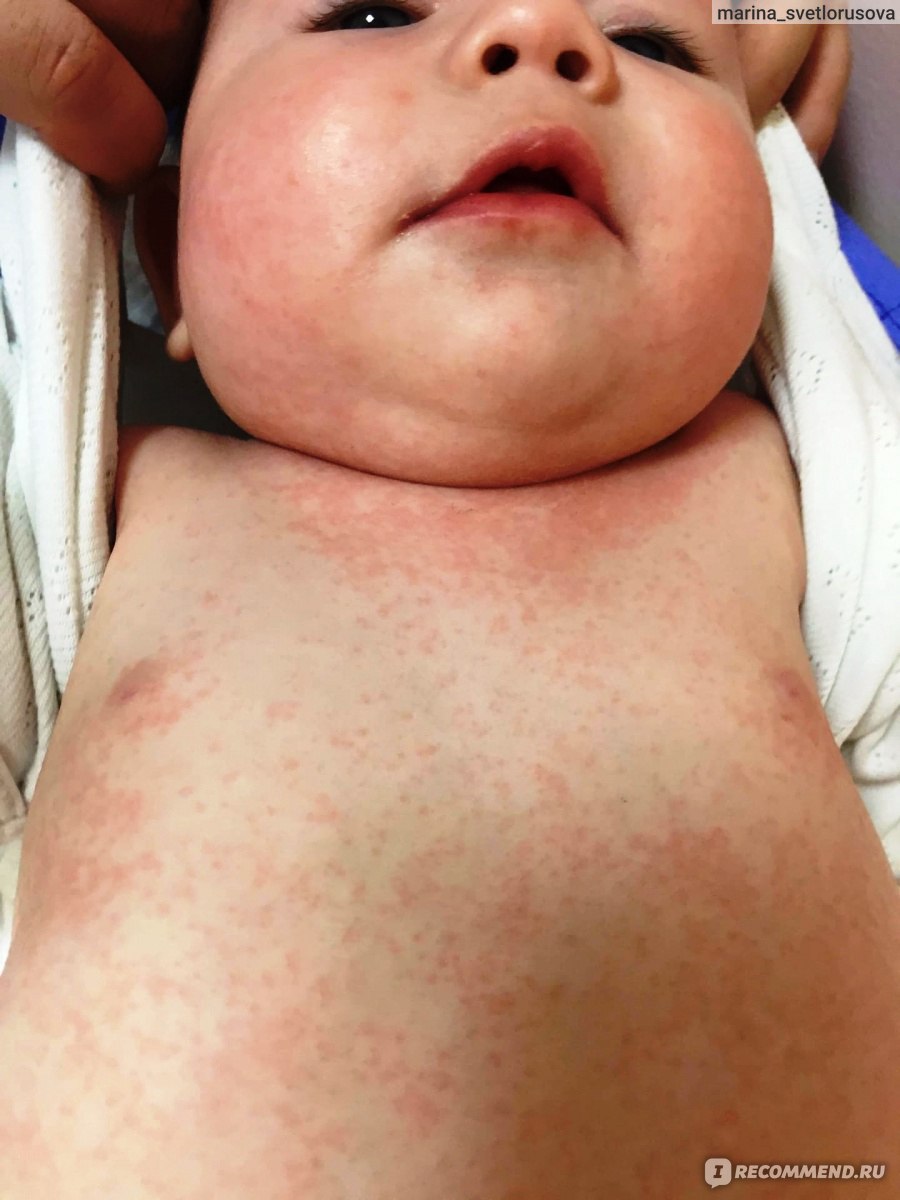 Симптомы аллергии на смесь у младенца. Как распознать?