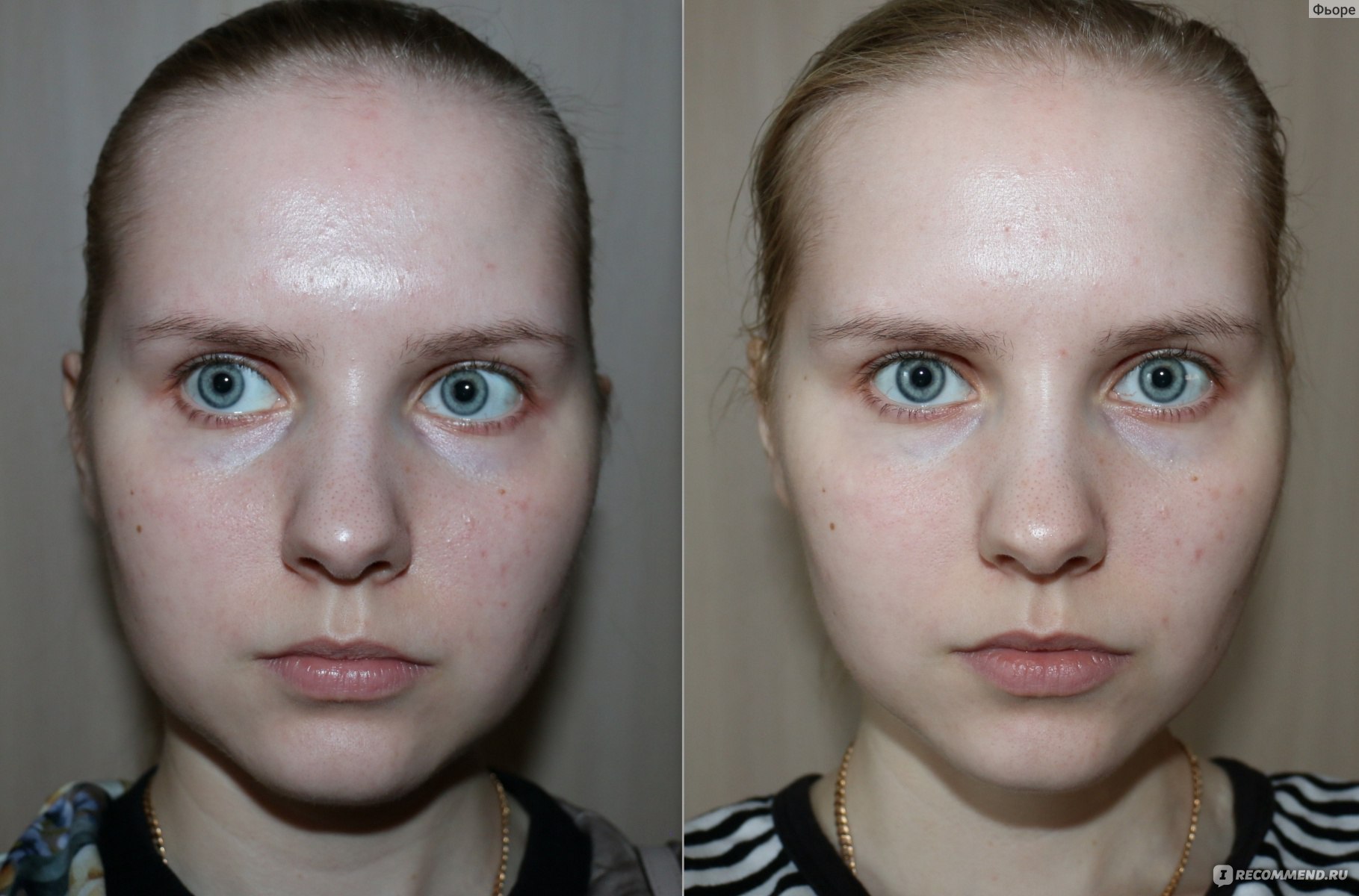 Вакуумная чистка лица фото до и после