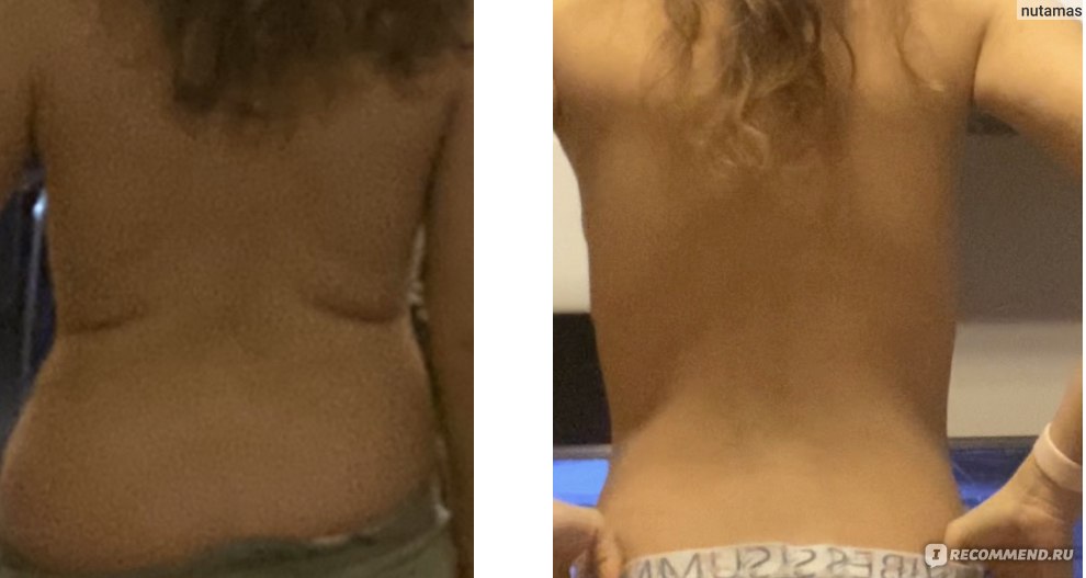 Вакуумно-роликовый массаж, процедура - «Вакуумный массаж в ДУ. Как убрать жир со спины. Фото до и после»