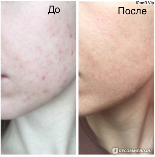 Салициловые диски против акне Stridex Single-Step Acne Control Maximum Alcohol Free фото