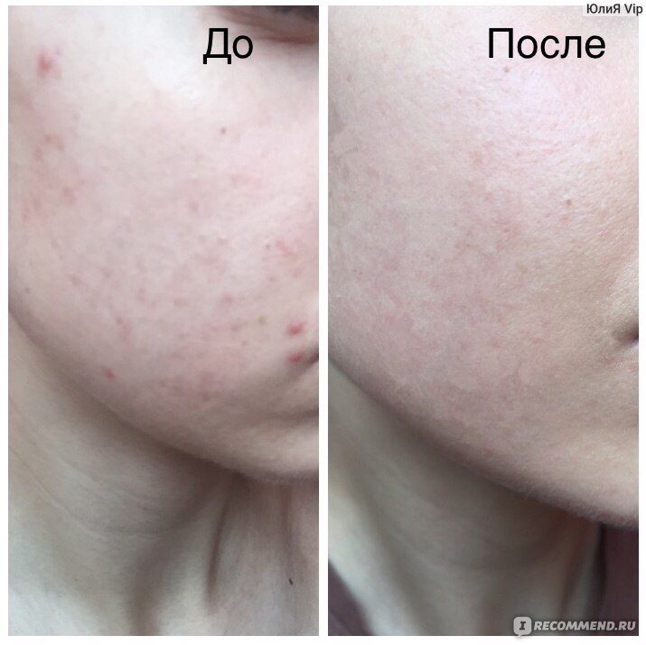 Салициловые диски против акне Stridex Single-Step Acne Control Maximum Alcohol Free фото